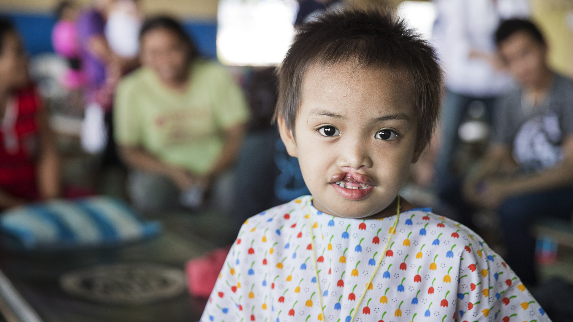 Una ragazza filippina prima del suo intervento chirurgico al labbro leporino