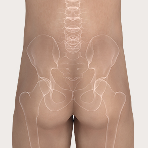 Fase 1 dell’applicazione di Mepilex Border Sacrum