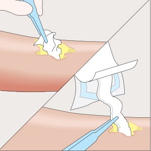 Fase 2 dell’applicazione di Mesalt